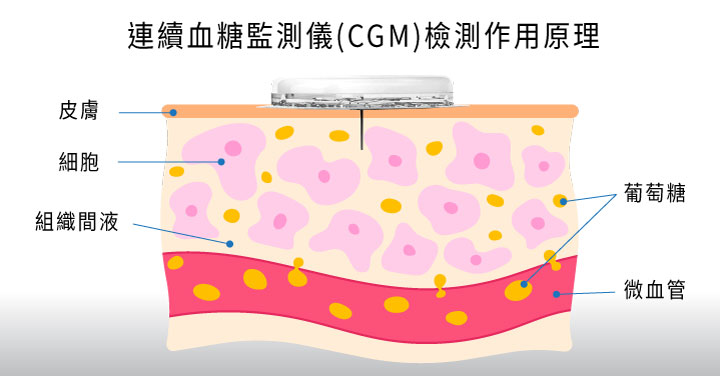 连续血糖监测仪,CGM,CGM检测作用原理