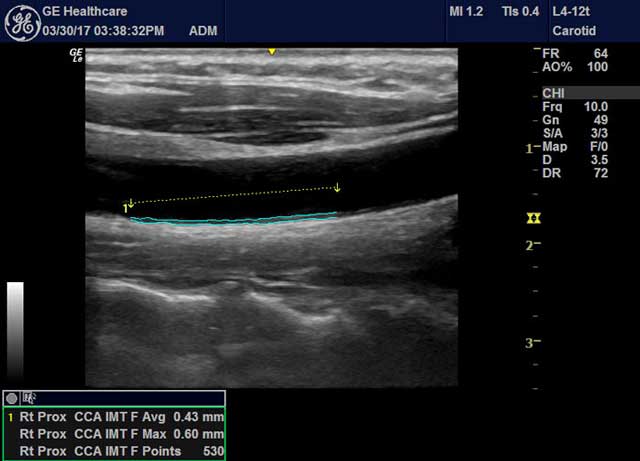 頸動脈內膜厚度超音波檢查