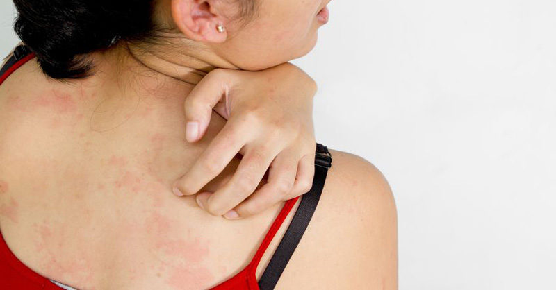 異位性皮膚炎 菁英診所基因營養功能醫學門診